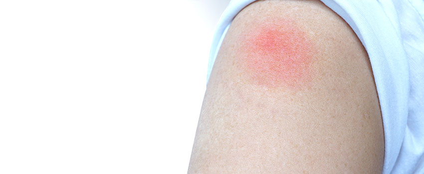 What You Need to Know About Heat Rash