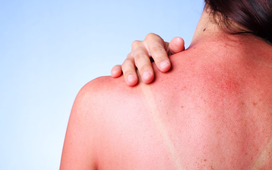 How Serious is Sun Poisoning?