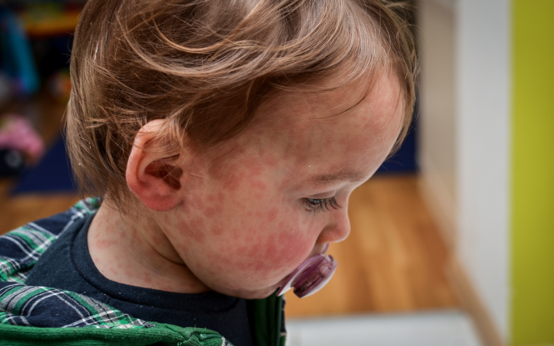 Measles Symptoms, Prevention, and When to Seek Medical Care